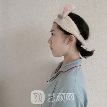 北京玉之光王明利面部吸脂怎么样？医生简介+面部吸脂实例分享