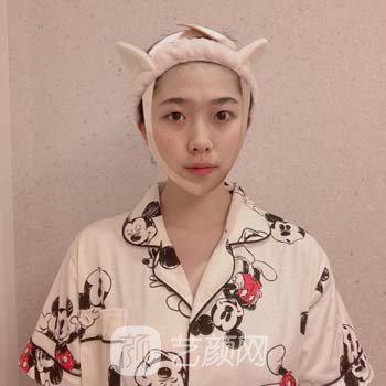 北京玉之光王明利面部吸脂怎么样？医生简介+面部吸脂实例分享