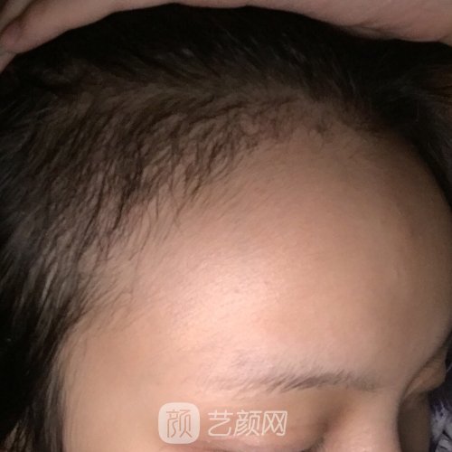 广州熙朵医疗美容医院怎么样？2022植发实例公布
