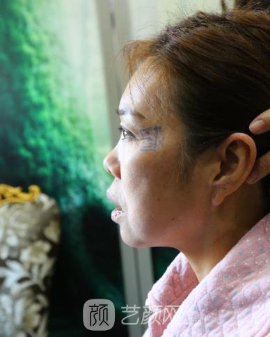 吴亚龙医生做拉皮怎么样？小切口拉皮真人实例更新