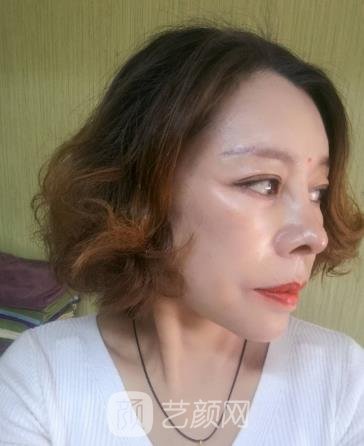 吴亚龙医生做拉皮怎么样？小切口拉皮真人实例更新