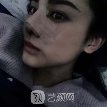 福州名韩温名赟医生做鼻子靠谱吗？医生简介+隆鼻实例更新