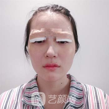 成都何军双眼皮实例，过后两个月眼睛布灵布灵，漂亮极了