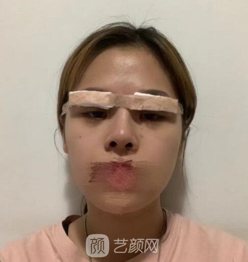 徐逸双眼皮失败修复实例，手术前后对比图片差别很大