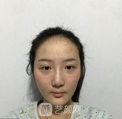 蒋思军双眼皮修复实例，修复之后美貌度和气质双重提升