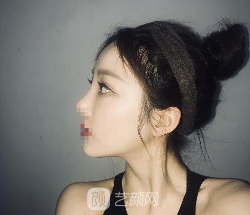 蒋思军双眼皮修复实例，修复之后美貌度和气质双重提升