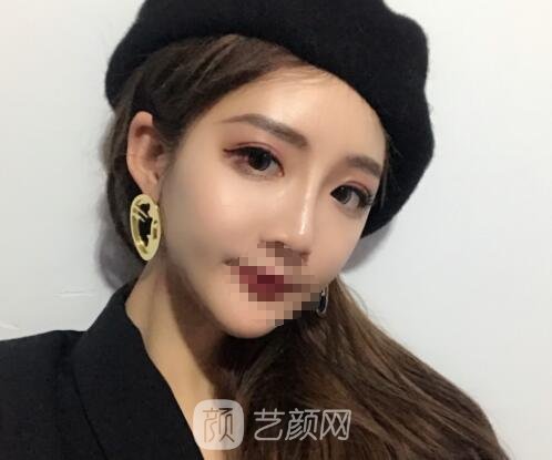 蒋思军双眼皮修复实例，修复之后美貌度和气质双重提升