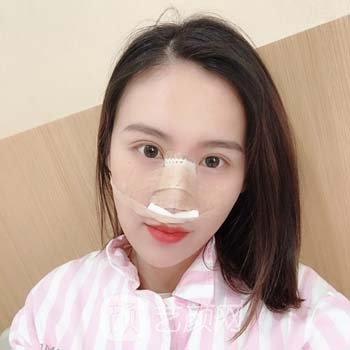 牛永敢做的鼻子实例：改善了鼻子，术后自信又乐观