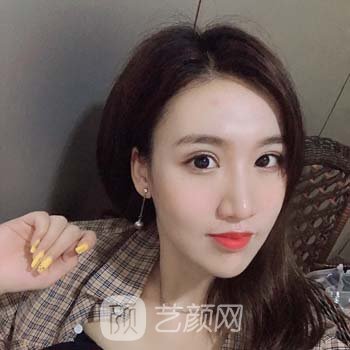 牛永敢做的鼻子实例：改善了鼻子，术后自信又乐观