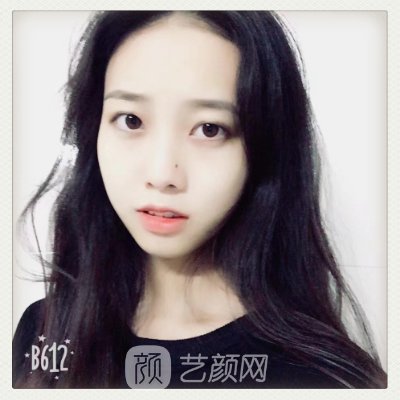 广州武警医院割双眼皮多少钱？新版收费标准及实例分享