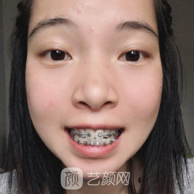 上海科美口腔门诊部牙齿正畸实例出炉｜内附体验成果图