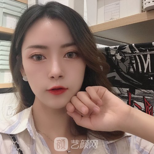 扬州施尔美去眼袋多少钱？崭新收费标准及实例分享