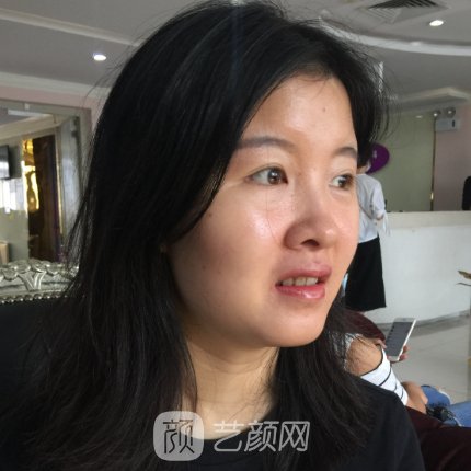 广州市皮肤病防治所龚业青皮肤除皱实例公开｜附体验对比图