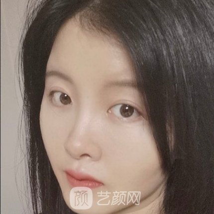 广州市皮肤病防治所龚业青皮肤除皱实例公开｜附体验对比图