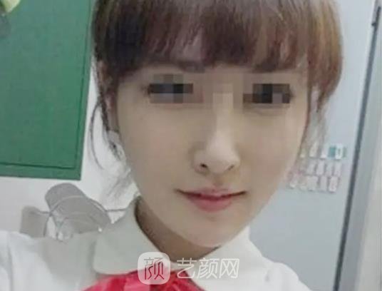 上海华美做下颌角怎么样？2022招牌实例出炉