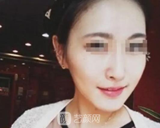 上海华美做下颌角怎么样？2022招牌实例出炉