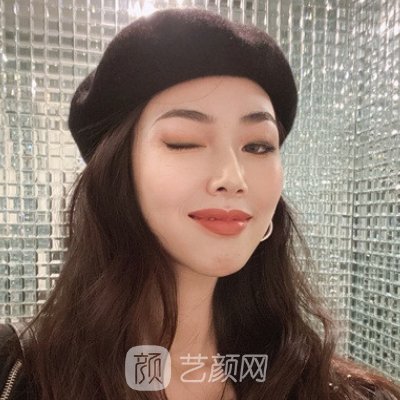 成都美绽美整形医院隆鼻实例展示|附体验成果图