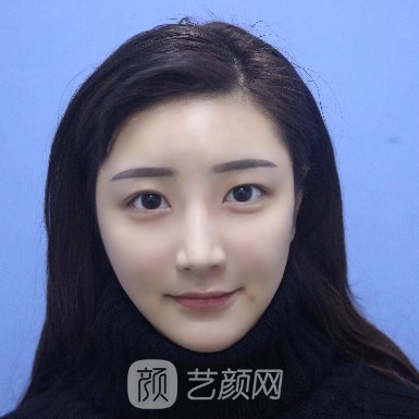 齐齐哈尔市第一医院整形科割双眼皮实例公开|附体验成果图