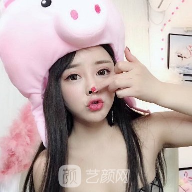 齐齐哈尔市第一医院整形科割双眼皮实例公开|附体验成果图