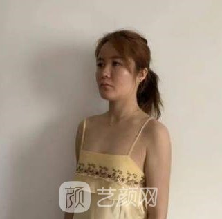 李朕自体脂肪隆胸实例，手术前后对比鉴赏，超级美丽