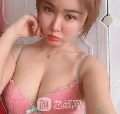 李朕自体脂肪隆胸实例，手术前后对比鉴赏，超级美丽