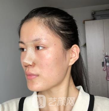 周顺波隆鼻失败修复的实例，手术前后对比图片展示