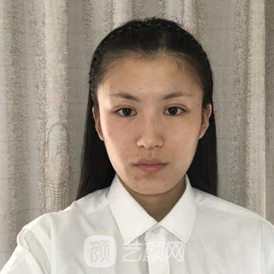 周顺波隆鼻失败修复的实例，手术前后对比图片展示