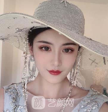 周顺波隆鼻失败修复的实例，手术前后对比图片展示