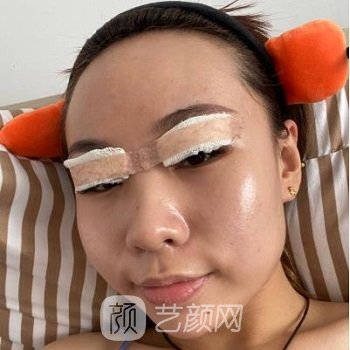 山东省立医院薛峰割平扇双眼皮图片，真人实例前后对比照片