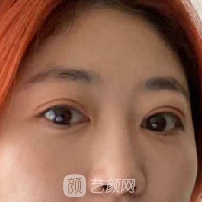 北京协和医院黄渭清做眼袋手术怎么样？全新体验实例一览