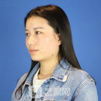 双眼皮手术修复期图，术后一个月超美蝶变体验真实实例分享