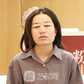 双眼皮手术修复期图，术后一个月超美蝶变体验真实实例分享