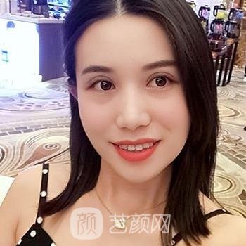 双眼皮手术修复期图，术后一个月超美蝶变体验真实实例分享