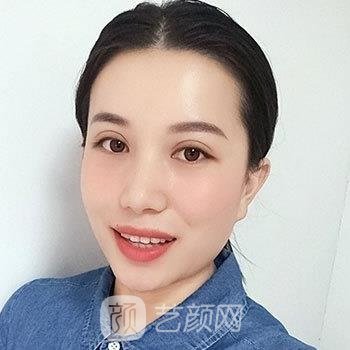 双眼皮手术修复期图，术后一个月超美蝶变体验真实实例分享