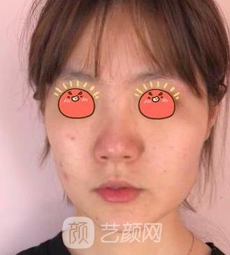 上海杨君毅磨骨失败修复实例，重新修复靓丽容颜并不难