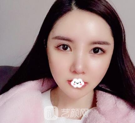 重庆李世荣院长磨骨实例，精致的小V脸轻松塑成，美美哒