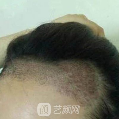 桂林贞韩植发技术怎么样？医院实力及实例曝光