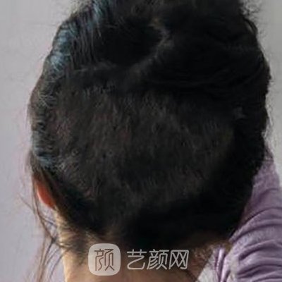 桂林贞韩植发技术怎么样？医院实力及实例曝光