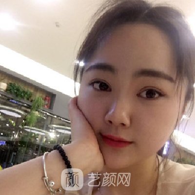 青医附院匡瑞霞割双眼皮技术怎么样？全新体验实例公开