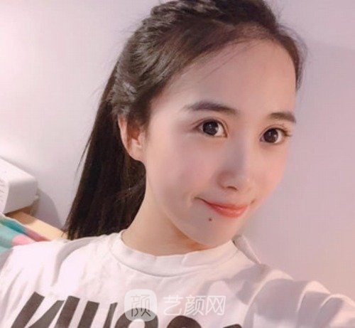 云大医院整形科双眼皮怎么样？技术好吗？医生简介+真人实例