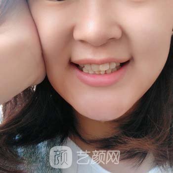 三水人民医院牙齿矫正多少钱？价格费用+牙齿矫正实例图片