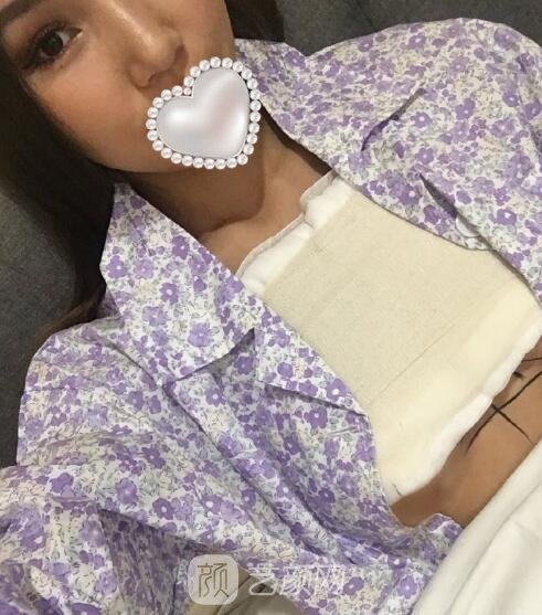 李健脂肪填充隆胸实例，术后65天前后对比照片更新