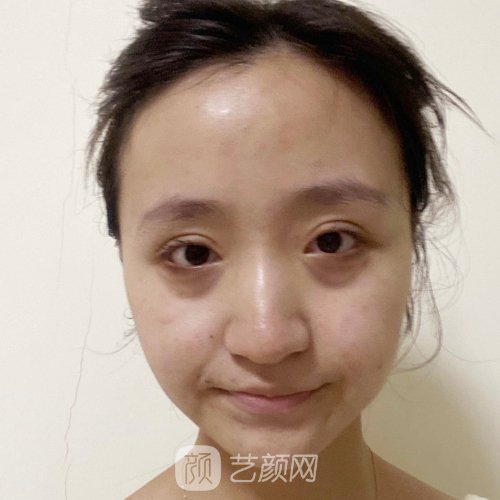 杭州美立方整形医院做眼袋好不好？2023实例展示