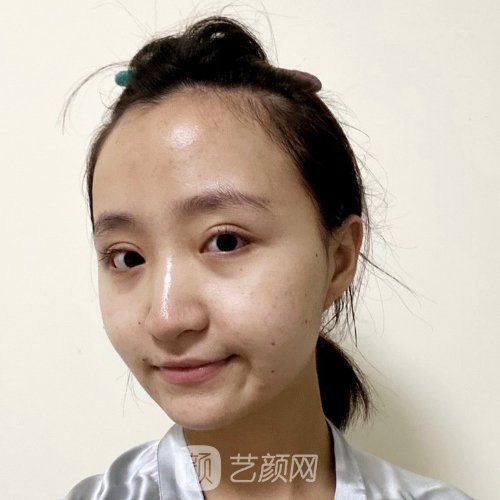 杭州美立方整形医院做眼袋好不好？2023实例展示