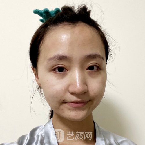 杭州美立方整形医院做眼袋好不好？2023实例展示