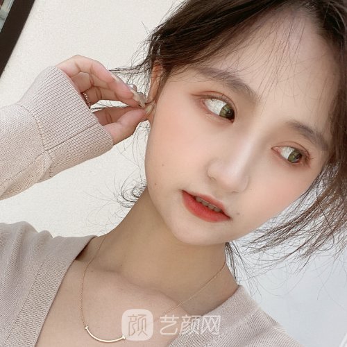 杭州美立方整形医院做眼袋好不好？2023实例展示