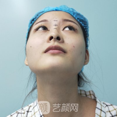 盐城艾美莉整形医院隆鼻实例展示｜体验对比图公开