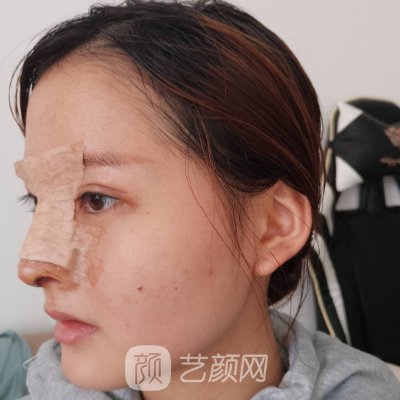 盐城艾美莉整形医院隆鼻实例展示｜体验对比图公开