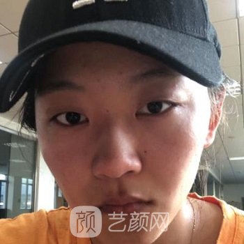 卿勇双眼皮实例，漂亮眼眸拯救整张脸~