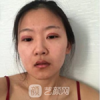 卿勇双眼皮实例，漂亮眼眸拯救整张脸~